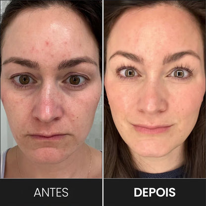 Cliente satisfeita com os resultados da máscara de led. Tratamento para os acometimentos da pele facial