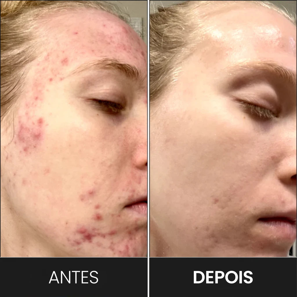 Foto mostrando os resultados do tratamento de acne e da inflamação com a máscara de ledterapia